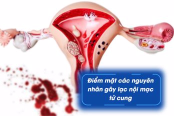 Điểm mặt nguyên nhân lạc nội mạc tử cung mà bạn nên biết!